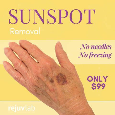 SUNSPOT REMOVAL ONLY $99