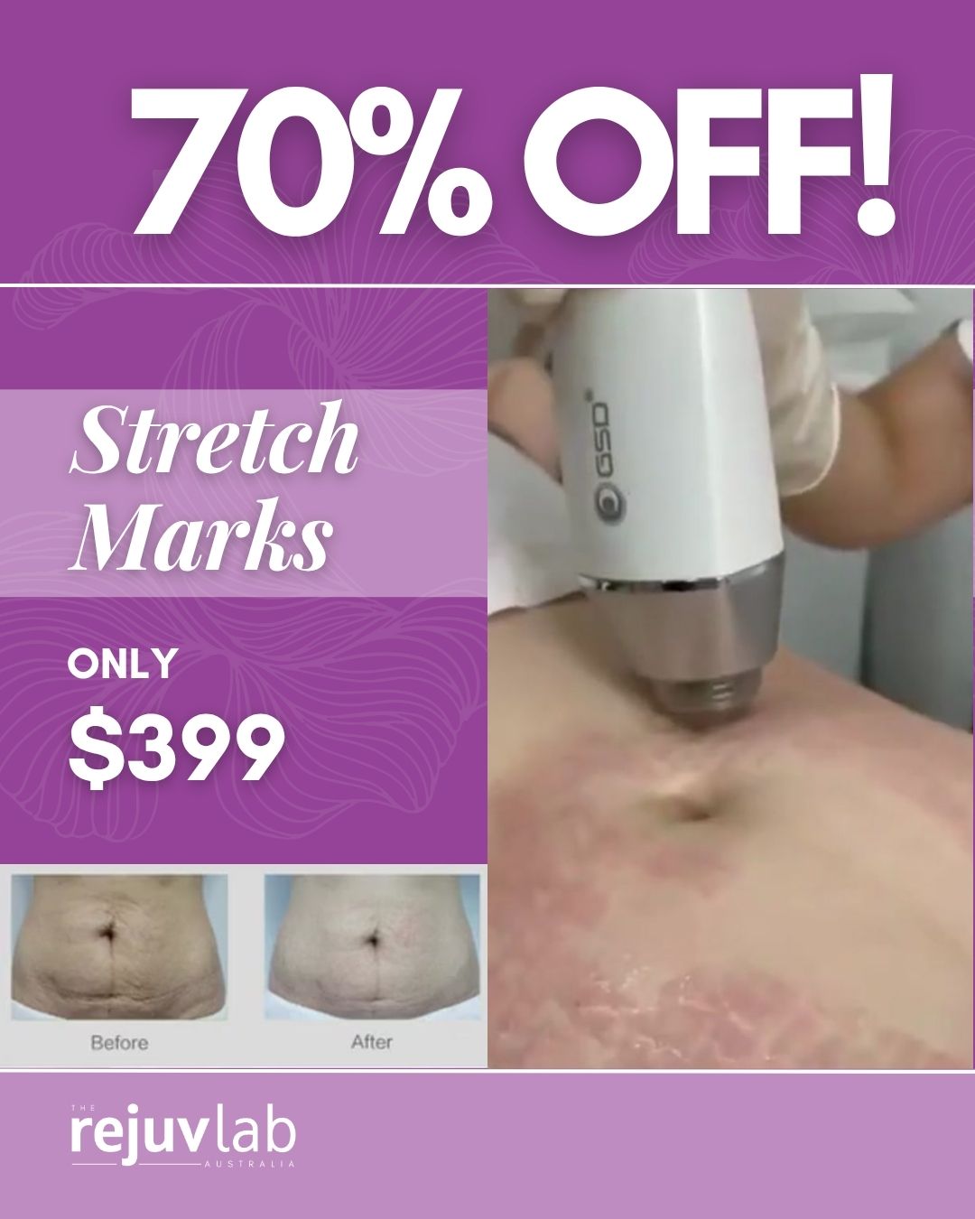 Stretch Mark Reduction - Fractional RF No Needles