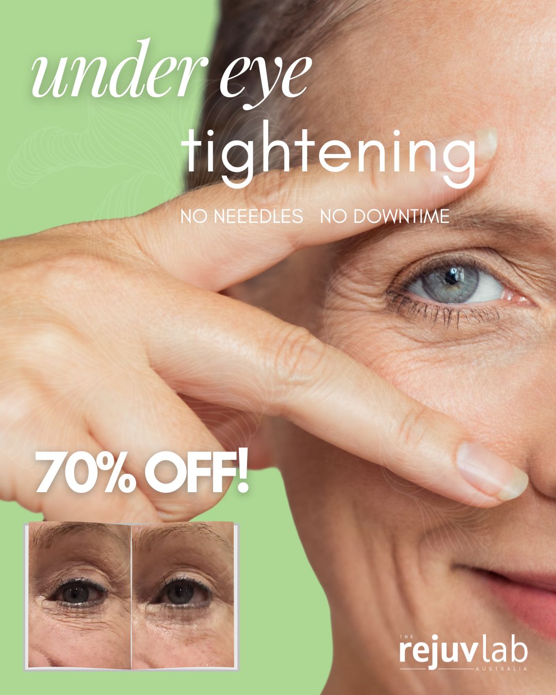 Under Eye Bag Reduction - No Needles Dotless Plasma