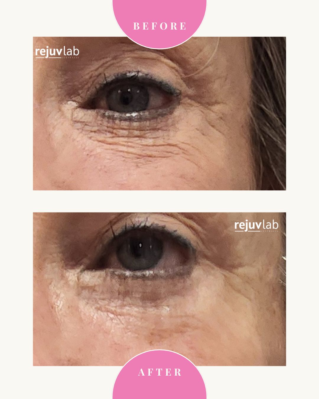 Under Eye Bag Reduction - No Needles Dotless Plasma