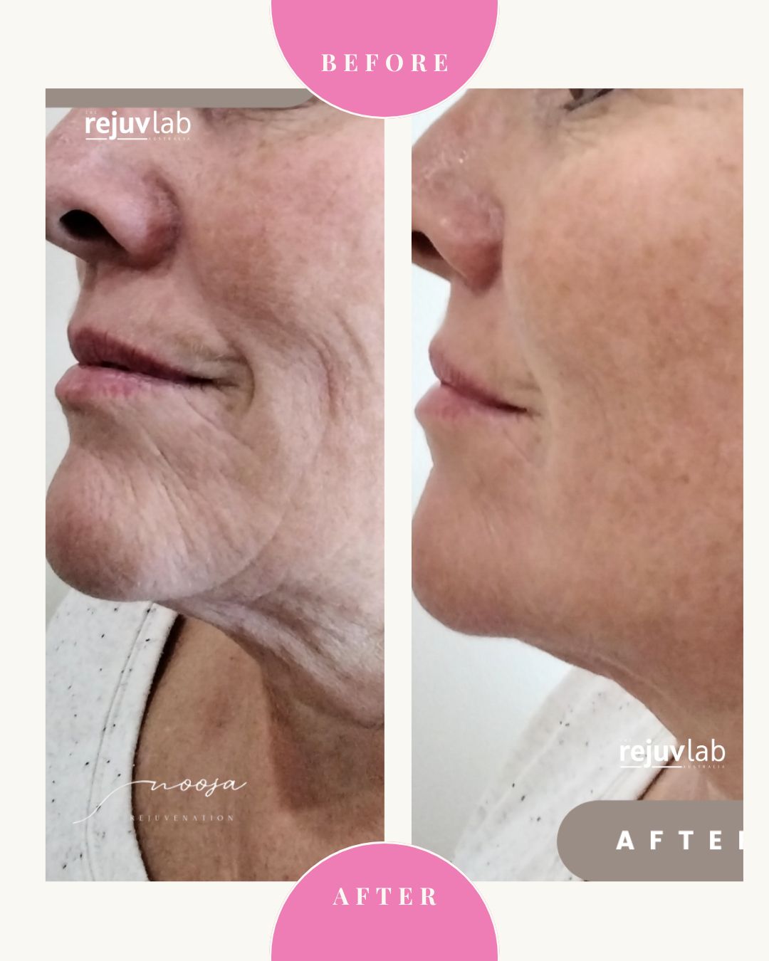 MASSIVE HIFU SALE 75% OFF! HIFU FACE LIFT + JAWLINE SCULPT + NIC THREADS + EYELID LIFT