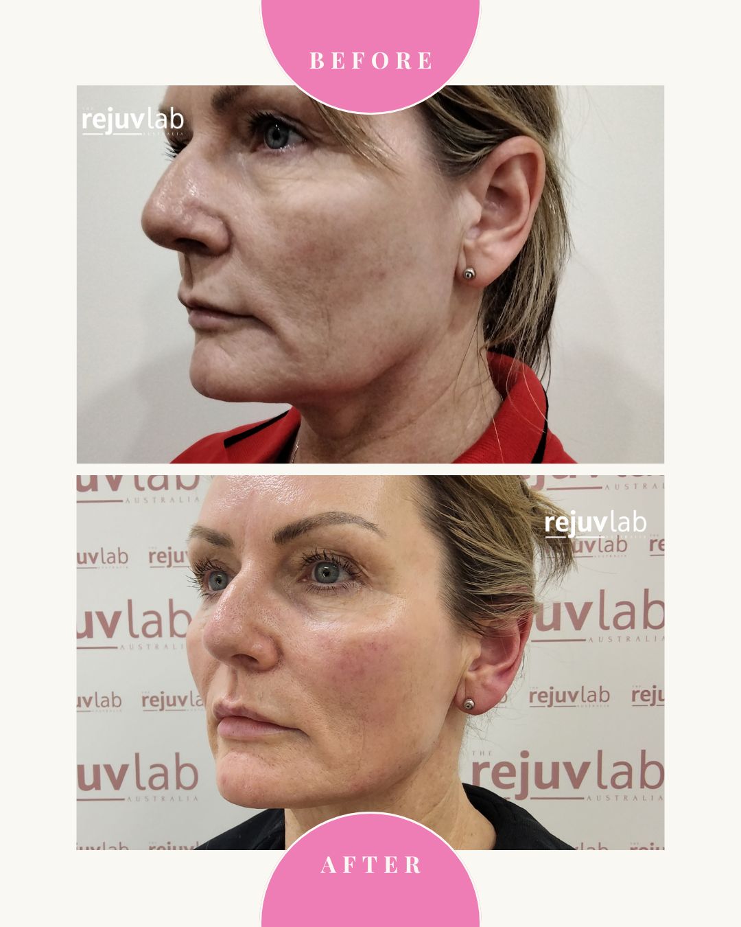 20D HIFU Face + Neck Lift - NEW HIFU!