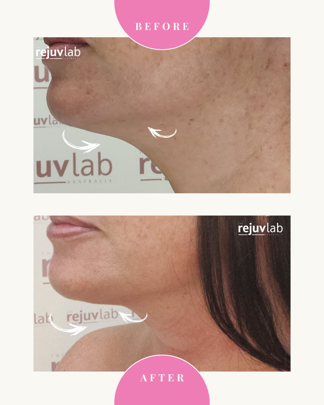 20D HIFU Face + Neck Lift - NEW HIFU!